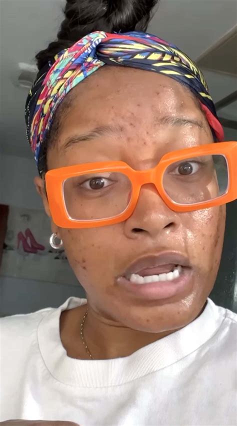 Keke Palmer Gets Real About Her Struggle With Adult Acne