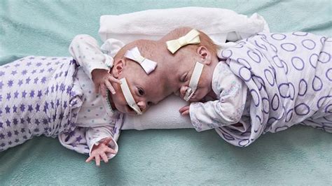 conjoined twins separated successfully at 10 months old au