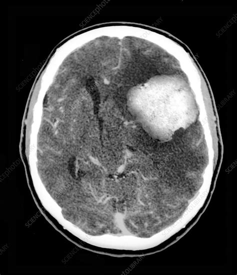 Benign Brain Tumour Ct Scan Stock Image C026 7914