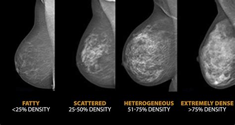 Breast Density Does It Really Matter – Life Among Women