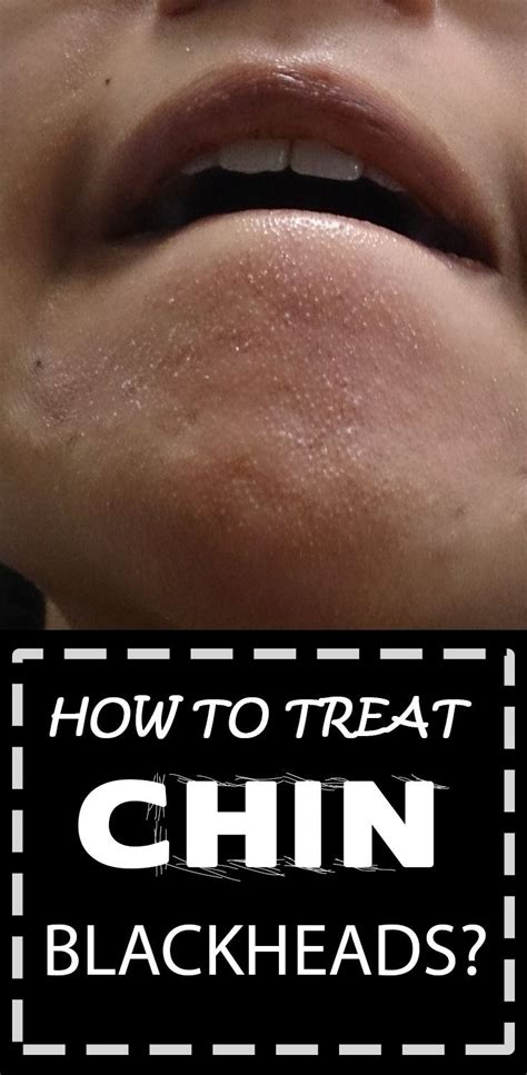 how to get rid of blackheads on the chin fast at home in