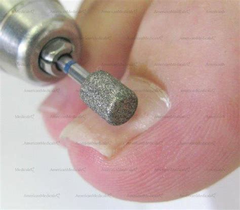 Safe-ToeÂ® Round-Edge Grinder Podiatry Bur - American Medicals