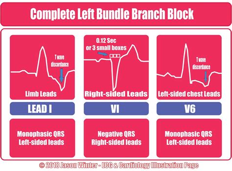 ecg educator blog bundle branch blocks