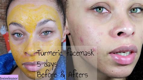 turmeric face masks   days results acne prone skin youtube