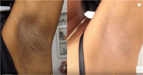 how to get rid of dark underarms naturally at home dark