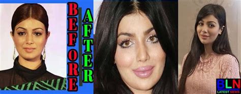 Bollywood Actress Before After Surgery In 2020 Bollywood