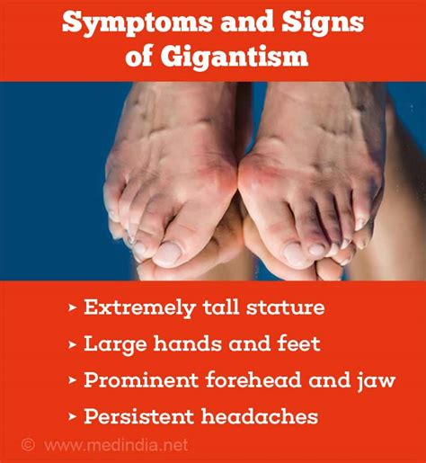 gigantism  signs symptoms diagnosis  treatment