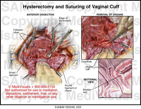 hysterectomy and suturing of vaginal cuff medical exhibit