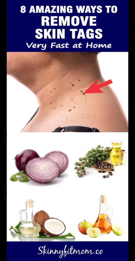 8 effective home remedies to remove skin tags at home in 2020 skin