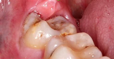 gonflement des gencives à l arrière de la bouche soins dentaires