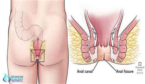 Anal Fissure Surgery In Iran Anal Fisure Treatment In
