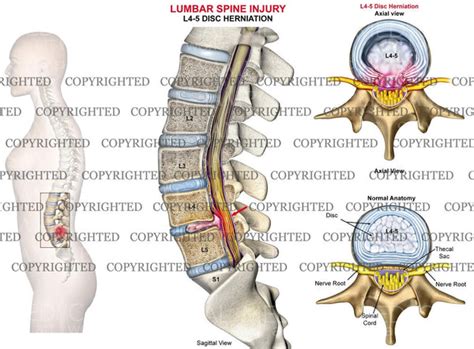 lumbar spine disc herniation female medical art works