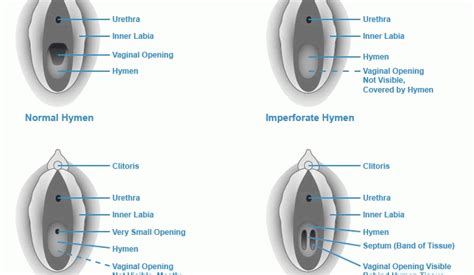 Hymen – Appearance Functions Break Of The Hymen – Healthy Food Near Me