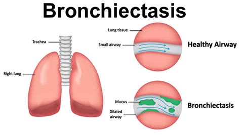 bronchiectasis causes signs symptoms diagnosis prognosis and treatment