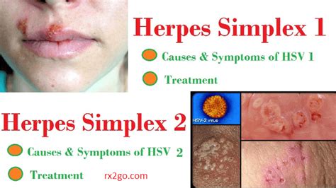 how to treat herpes simplex topic