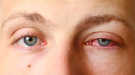 pink eye conjunctivitis symptoms  treatment page   health