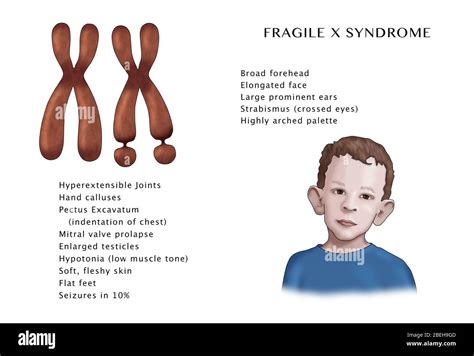 Cromosoma X Frágil Fotografías E Imágenes De Alta Resolución Alamy