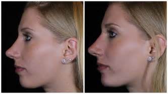 reshaping  nose  surgery med spa broomfield