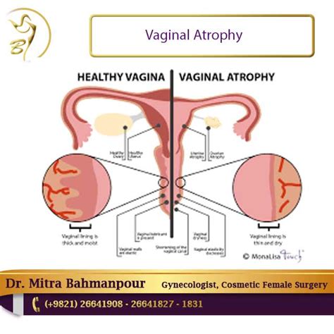 vaginal atrophy vaginal atrophy symptoms vaginal