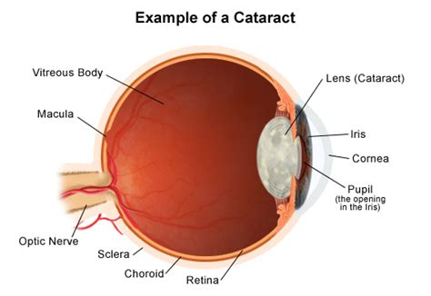 cataracts  children
