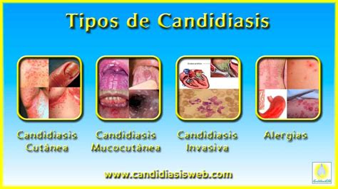 Tipos Clínicos De Candidiasis