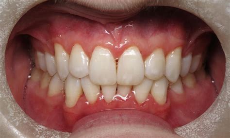 gum infections dentist lake charles la images  gingivitis