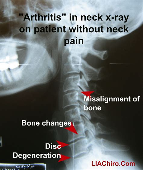 arthritis  chiropractic