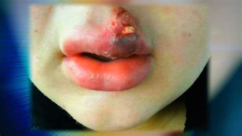body fixers shocks as man s lips explode after lip fillers go wrong