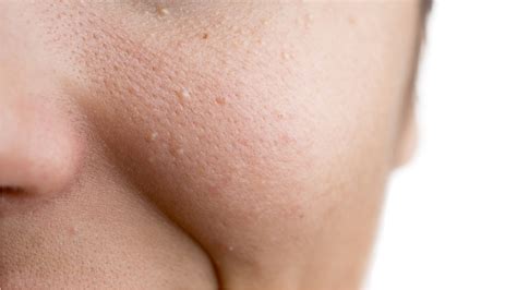 those tiny bumps on your skin might be milia now leave