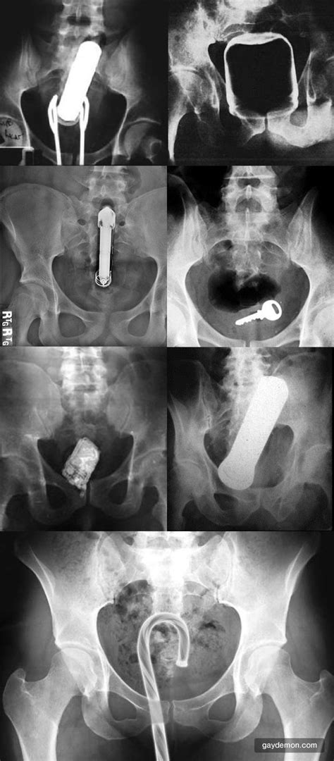 anal disasters caught on x ray gaydemon
