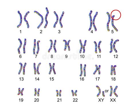 karyotype des katzenschrei syndroms oder des katzenschreisyndromalias syndroms p stock