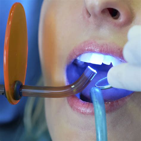 modern filling techniques somerset dental care
