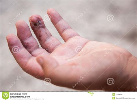 beschadigde vinger na verrichting stock afbeelding image  ongeval mens