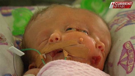 conjoined twins born with one body but two faces fight for survival