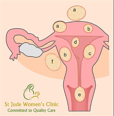 Uterine Fibroid St Jude Women S Clinic