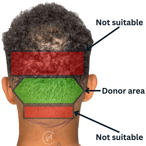 hair   safe donor area hair restoration questions  answers hair restoration