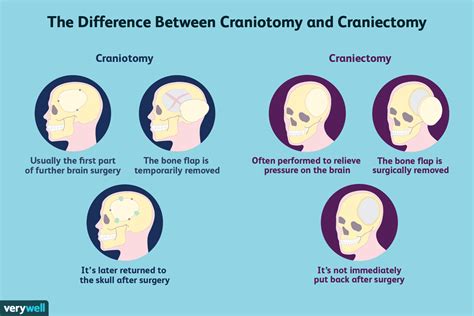 der unterschied zwischen kraniotomie und kraniektomie
