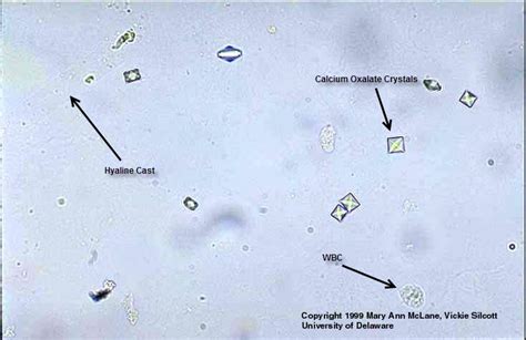 microscopic urine sediment exam results medical