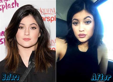 Kylie Jenner Plastic Surgery Before And After