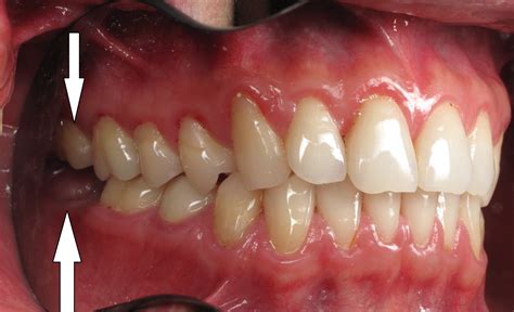 upper  teeth hurt teethwalls
