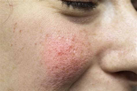 acne rosacea vitality family health