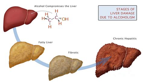 Stages Of Liver Damage Photograph By Monica Schroeder