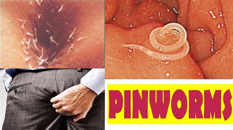 itchy anus parasites symptoms treatment itchy bottom pruritus ani is revue