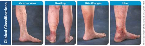 varicose veins manchester vein clinic