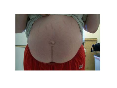 c section scar pictures photo gallery