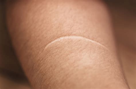 older helps skin heal   scarring   researchers
