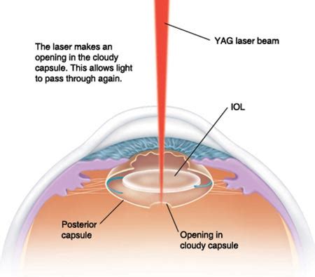 yag capsulotomy complications top eye doctor ophthalmologist nyc