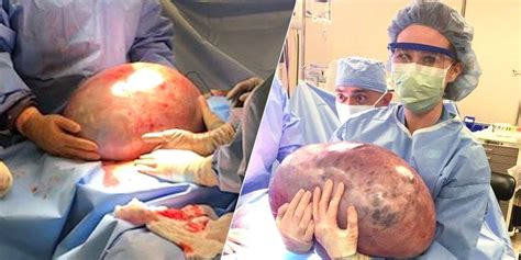 This Woman Had A 50 Pound Ovarian Cyst Removed After Months Of