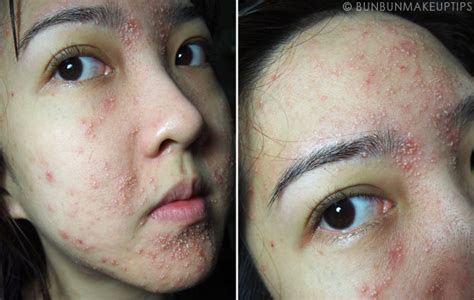 beauty blogger posts horrifying results of a facial gone wrong