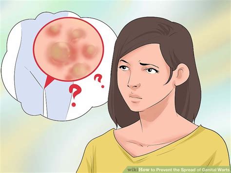 3 Ways To Prevent The Spread Of Genital Warts Wikihow
